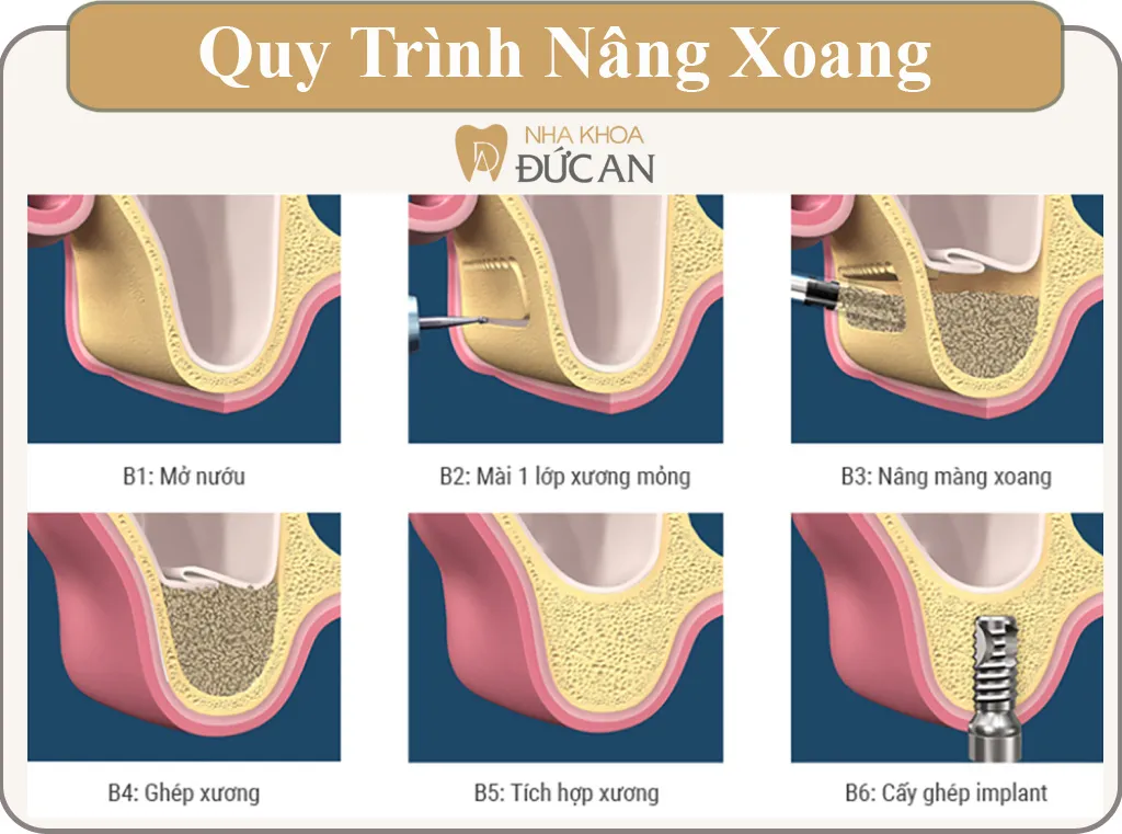 Mô phỏng kỹ thuật ghép xương hỗ trợ cấy ghép Implant cho người bị tiêu xương