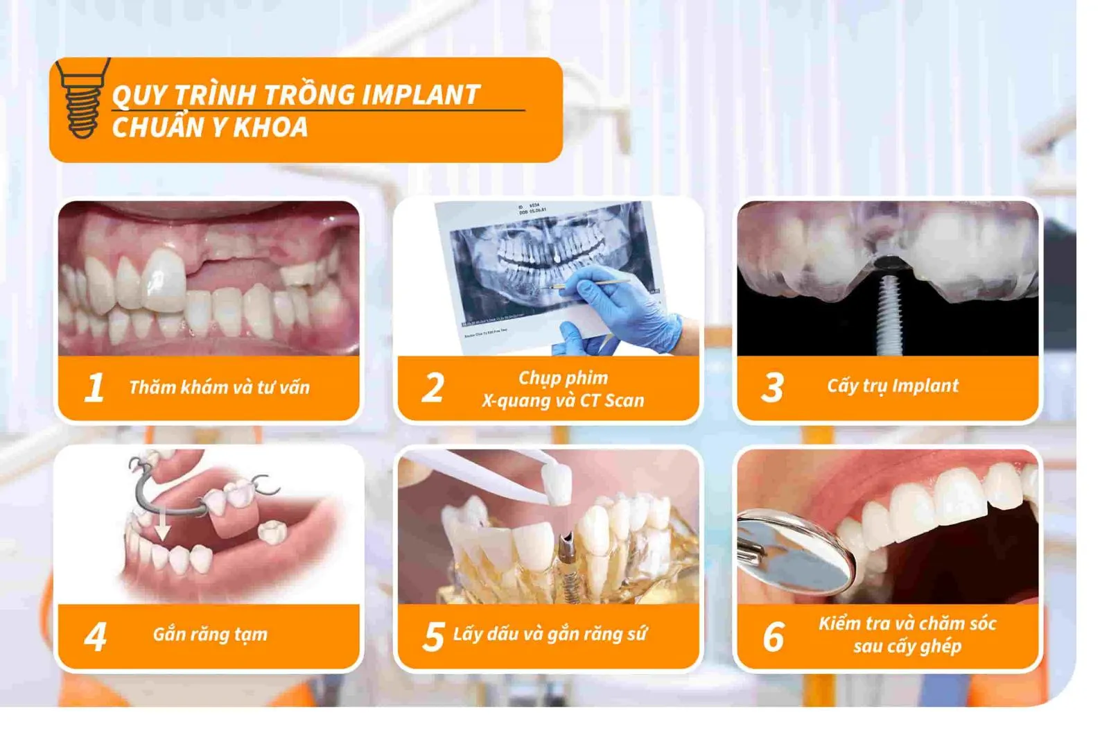 quy-trinh-trong-implant-chuan-y-khoa Cấy ghép Implant là một trong những dịch vụ thế mạnh hàng đầu tại Nha khoa Lê Hưng